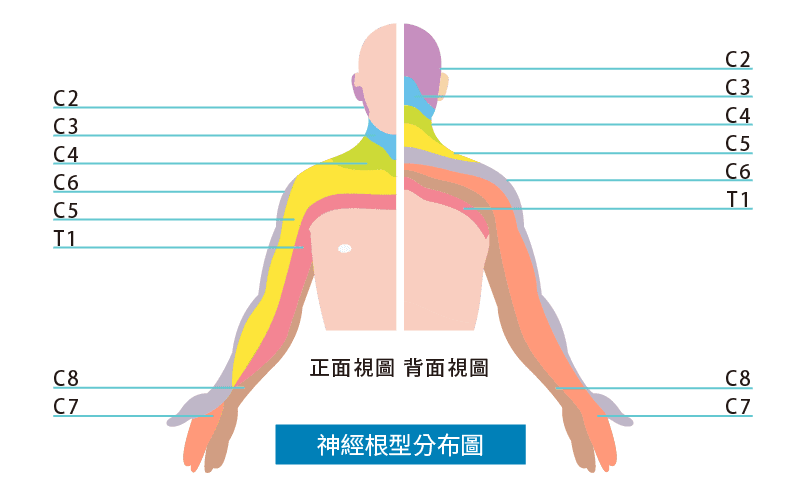 神經根型